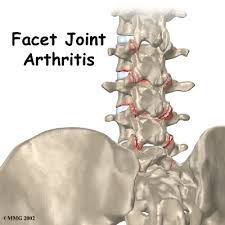 ساییدگی کمر ,آرتروز کمر ,تنگی نخاع , ساییدگی مهره های کمر ,  ساییدگی فاست , facet joint